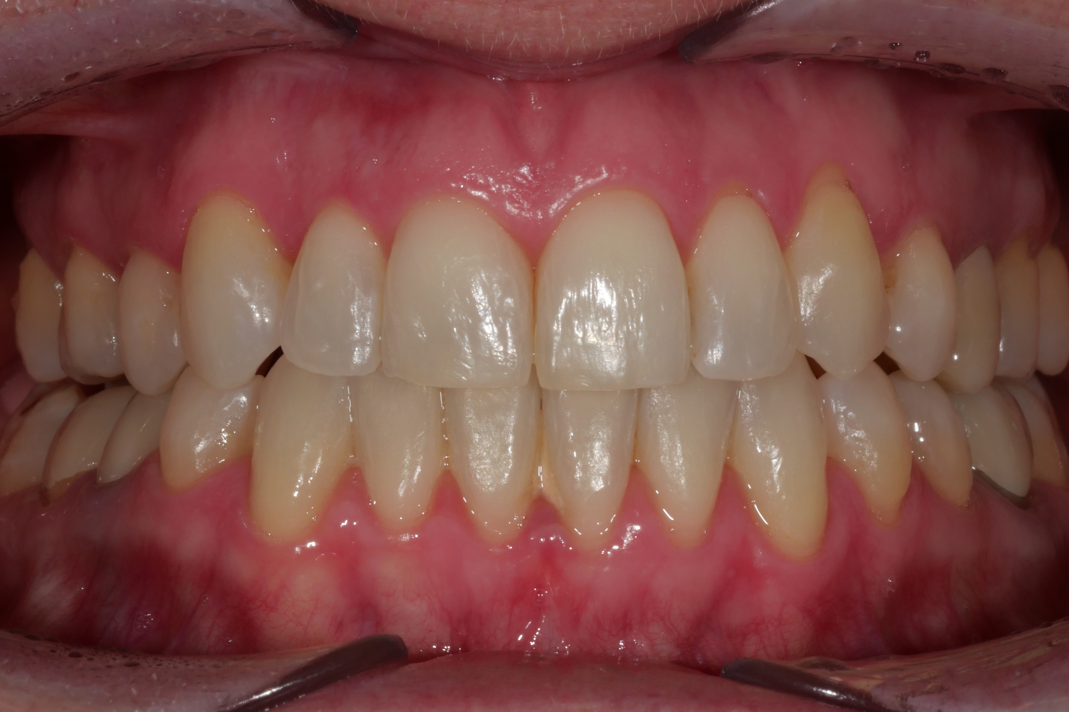 Before
